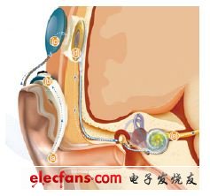 圖5,植入耳蝸將聲音轉(zhuǎn)換為電脈沖，送給聽覺神經(jīng)。話筒將聲音捕捉給聲音處理器（a）。聲音處理器將聲音轉(zhuǎn)換為詳細的數(shù)學(xué)信息 （b）。