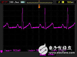 監(jiān)護(hù)儀模擬輸出端顯示出從電力線耦合而來的噪聲