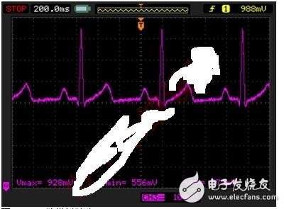 基于微功耗IC實現(xiàn)延長監(jiān)護儀電池壽命的方案解析