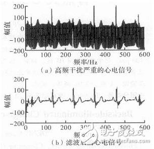 心電信號(hào)檢測(cè)中濾除肌電干擾的方法解析